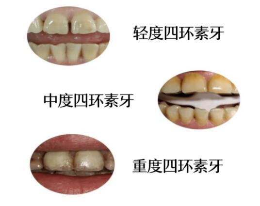 上海哪家口腔种植牙医生技术更强？价格表参考分享