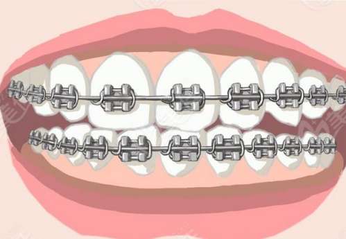 门牙矫正方案费用参考，尽请期待！