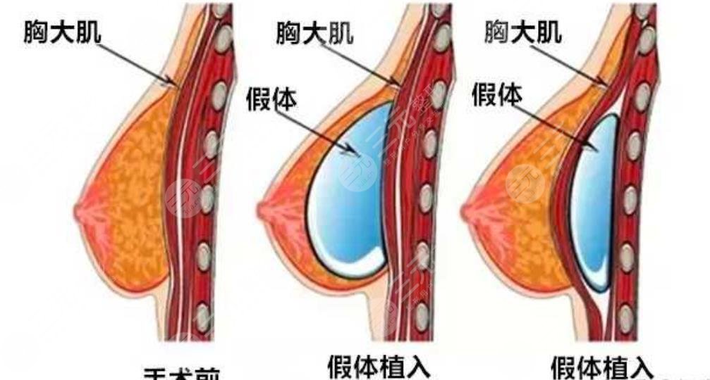 隆胸