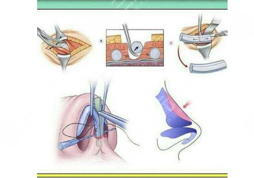 鼻部整形手术
