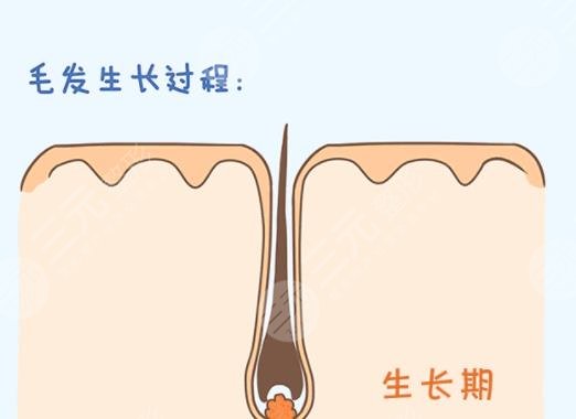 头发移植