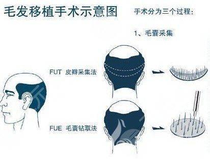 头发移植术后需要如何保养?