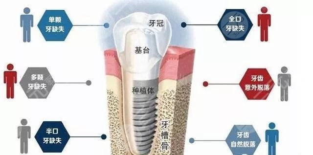 种植牙禁忌人群有哪些?