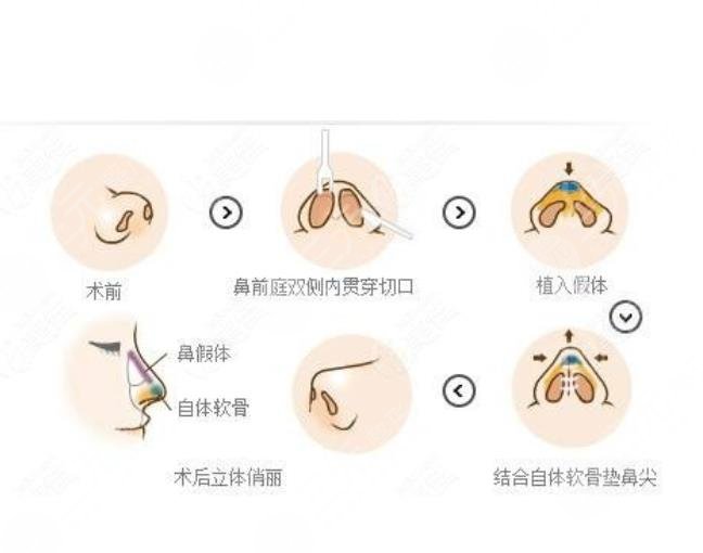 隆鼻手术需要注意的事项有哪些?