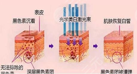 光子嫩肤手术有哪些功效?