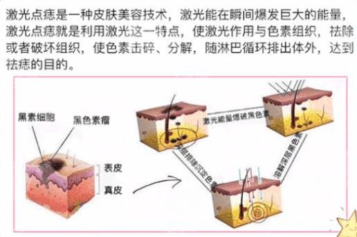 激光去黑痣注意事项有哪些?