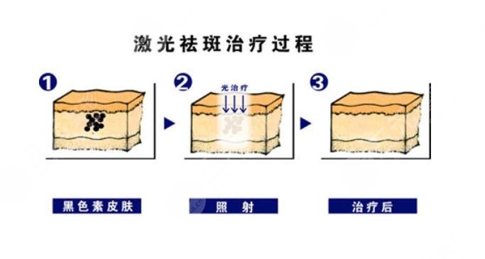 激光祛斑是如何操作的?