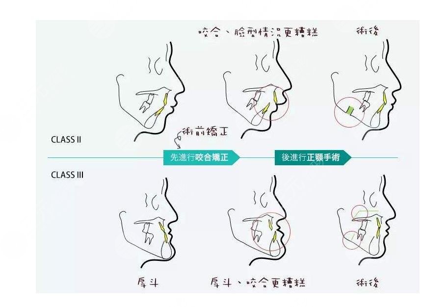 正颌手术操作步骤