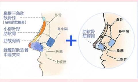 假体隆鼻