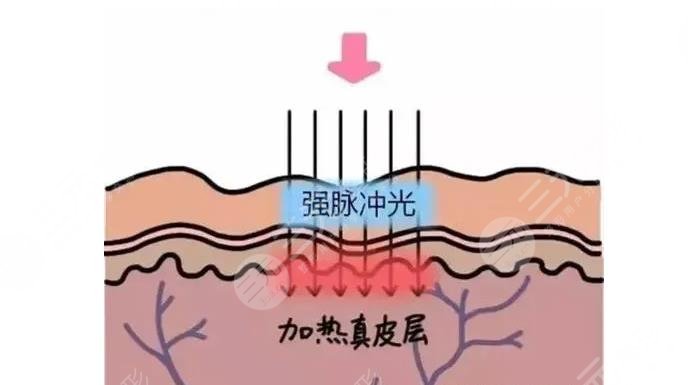 光子嫩肤手术那些功效?