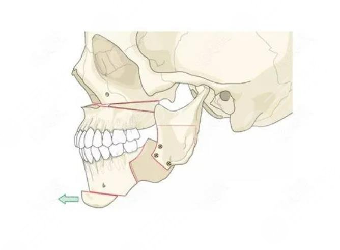 正颌手术注意事项