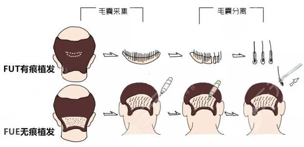 河北省二院整形科植发中心人气项目：(1)毛发种植