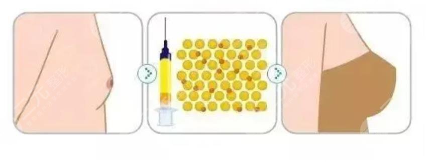 脂肪隆胸