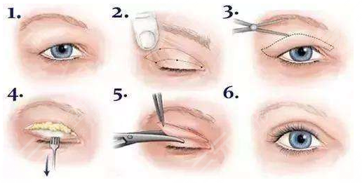 全切双眼皮整形