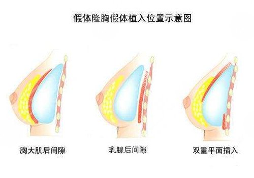 假体隆胸：