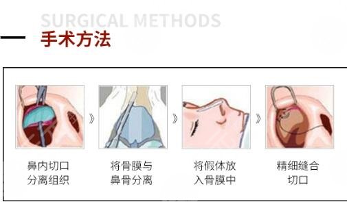 自体软骨隆鼻手术