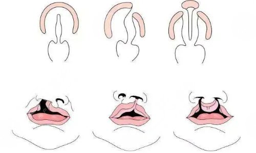 武汉大学口腔医院正颌与唇腭裂整形外科热门项目科普