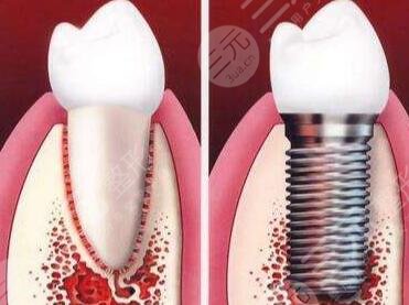 广州军区总医院口腔科种植牙案例