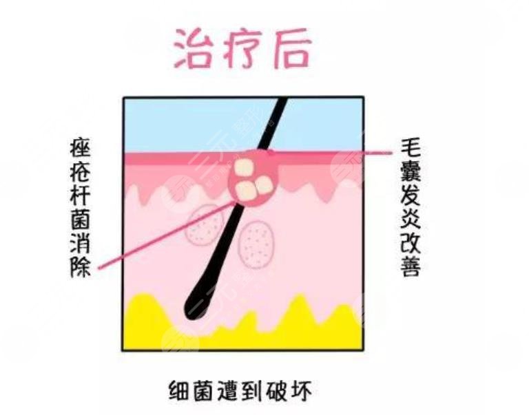 中山三院美容激光科红蓝光去黑色素案例：术后