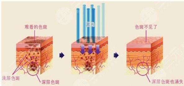 广州南方医院祛斑