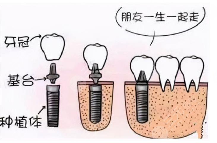 广州中医药大学第一附属医院口腔科种植牙案例：术前