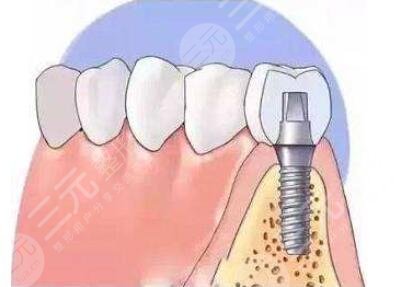 南方医科大学第三附属医院种植牙效果
