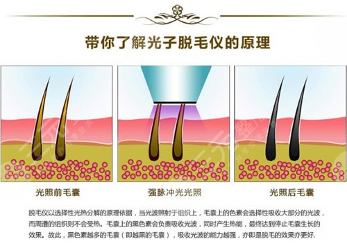 北京大学深圳医院激光脱毛案例图：术前