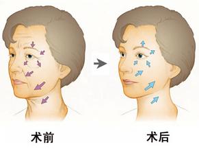 上海伊莱美除皱示意图