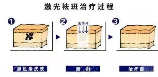 广东省第二人民医院祛斑前后对比