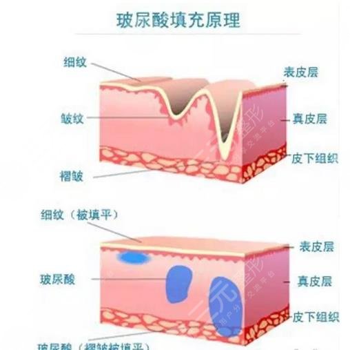 玻尿酸填充额头