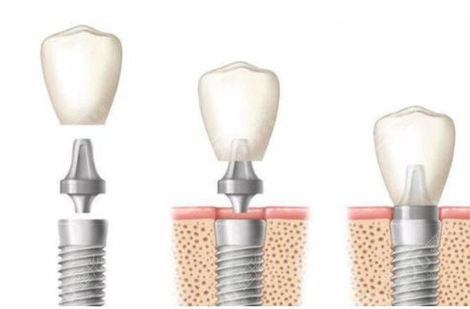 种植牙整形