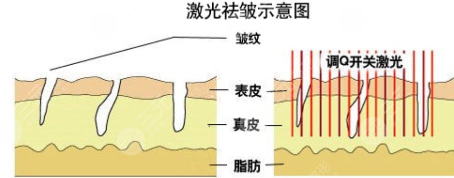 激光除皱