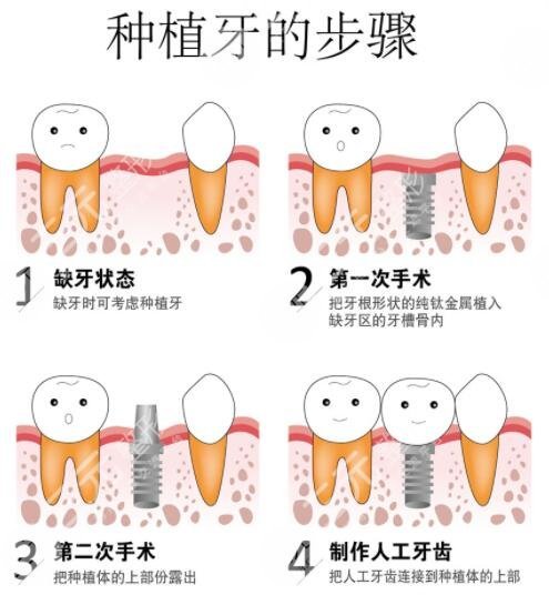 吉林江城口腔医院种植牙