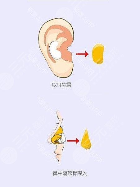 郑州大学第二附属医院整形科项目科普：隆鼻