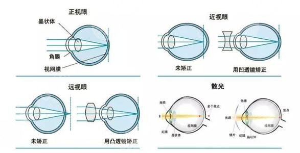 眼睛多少度适合做近视眼激光手术