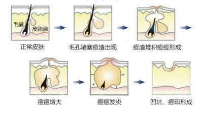 彩光祛痘的注意事项?