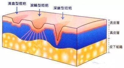 彩光祛痘反弹吗?