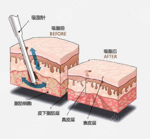 吸脂塑形