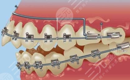 上海9院牙齿正畸案例