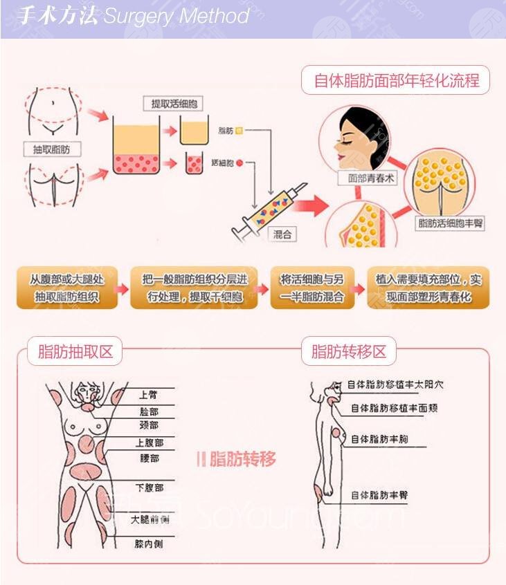 自体脂肪填充优缺点