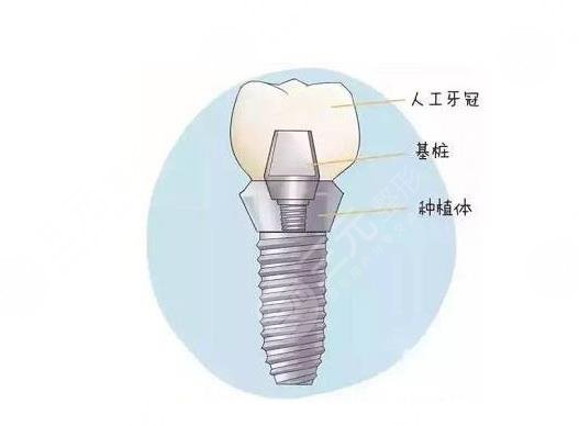 口腔医疗项目科普之种植牙介绍