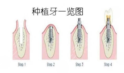 上海九院口腔科牙齿种植手术案例过程分享