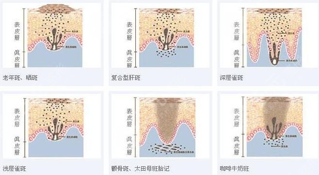 赣州市人民医院整形科激光祛斑案例分享