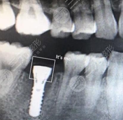 北京中诺口腔医院种植牙案例分享