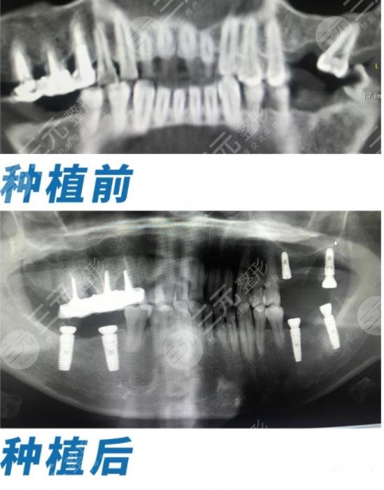 杭州美奥口腔医院种植牙案例分享