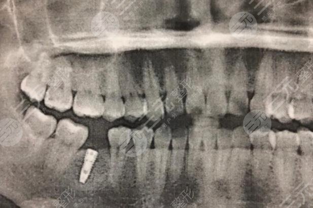 福州维乐口腔医院种植牙案例分享