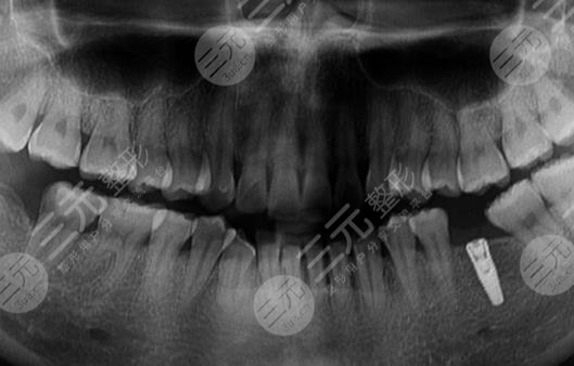 昆明雅度口腔医院种植牙案例