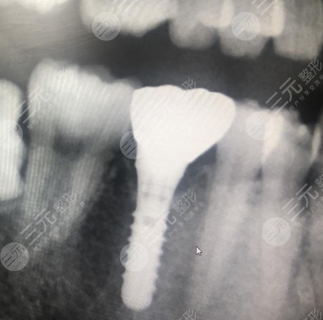 上海瑞泰口腔医院种植牙案例分享