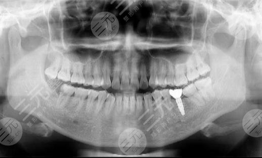 广州广大口腔医院种植牙案例分享