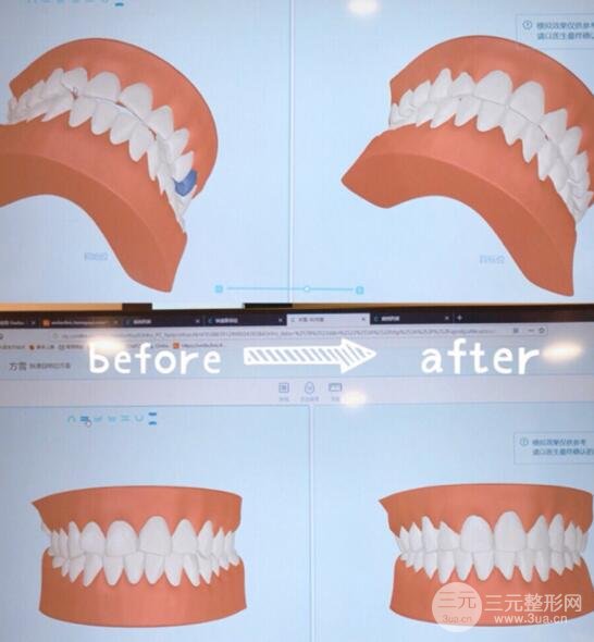 沈阳牙齿矫正果反馈
